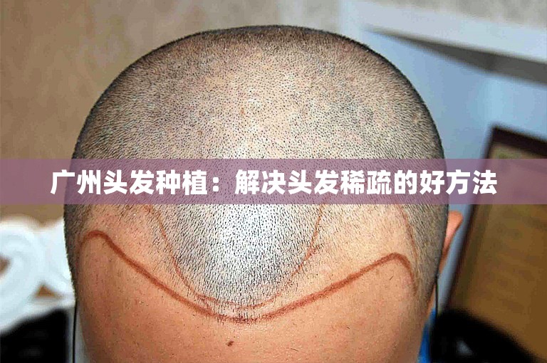 广州头发种植：解决头发稀疏的好方法