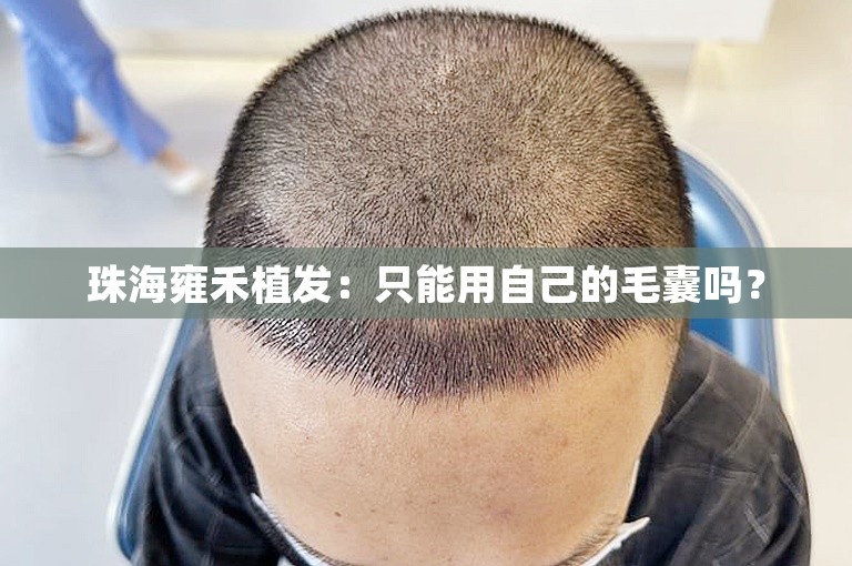 珠海雍禾植发：只能用自己的毛囊吗？