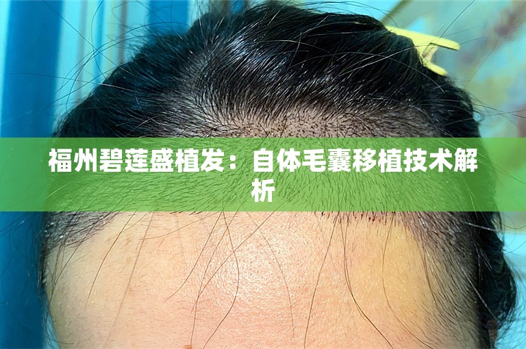 福州碧莲盛植发：自体毛囊移植技术解析