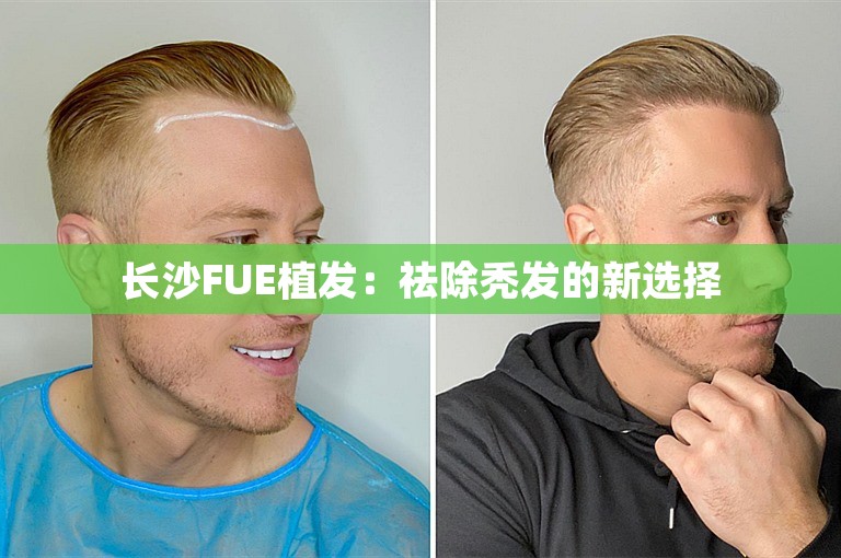 长沙FUE植发：祛除秃发的新选择