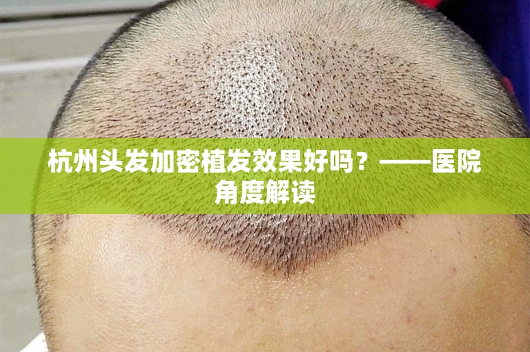 杭州头发加密植发效果好吗？——医院角度解读