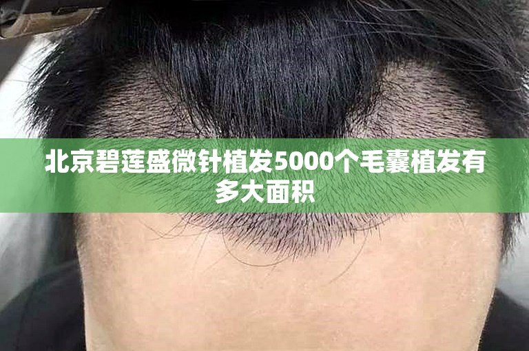 北京碧莲盛微针植发5000个毛囊植发有多大面积