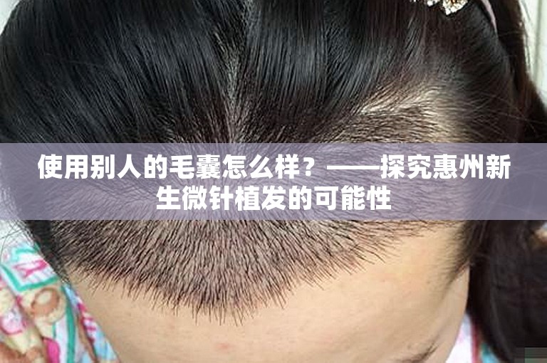 使用别人的毛囊怎么样？——探究惠州新生微针植发的可能性