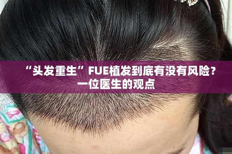 “头发重生”FUE植发到底有没有风险？一位医生的观点