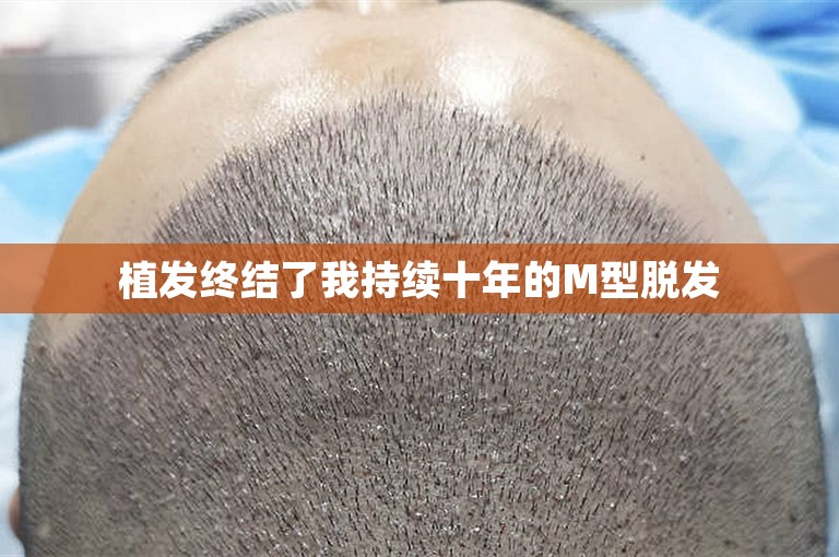 重庆有名的植发医院选择攻略