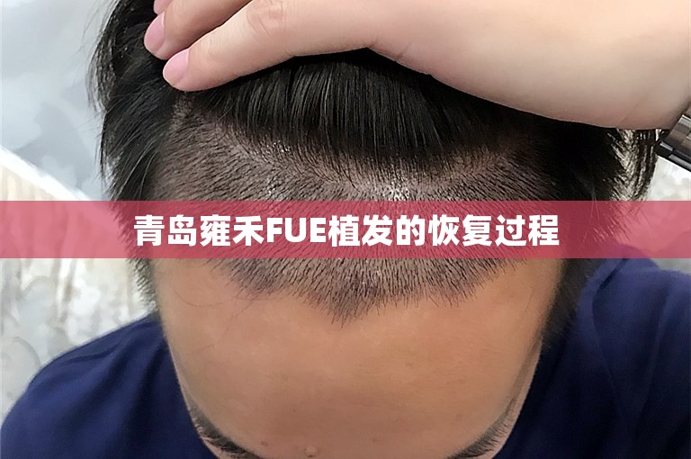 青岛雍禾FUE植发的恢复过程