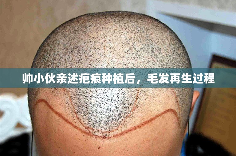 徐州头发种植好点的植发医院怎么选