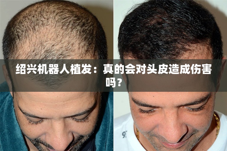 绍兴机器人植发：真的会对头皮造成伤害吗？