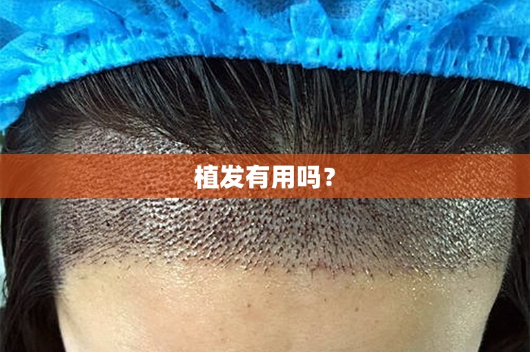 徐州技术最好的植发专家怎么选