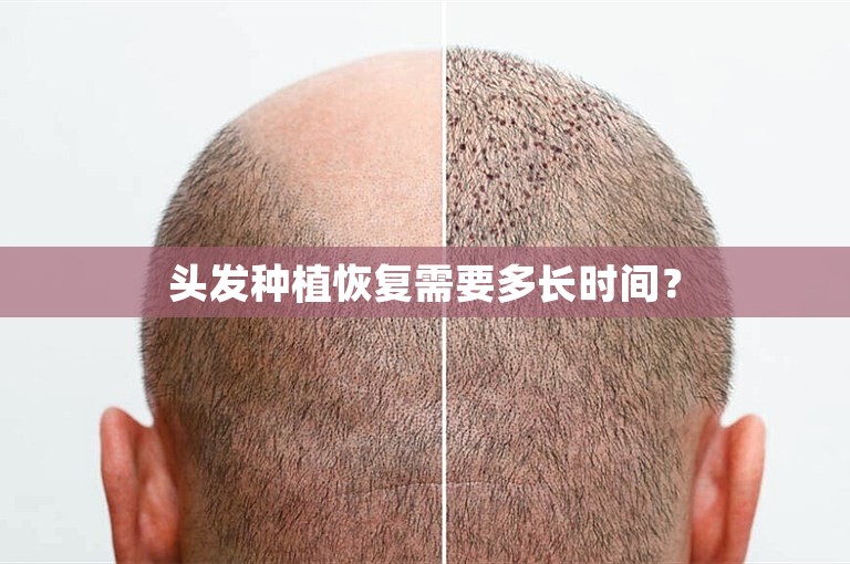 头发种植恢复需要多长时间？
