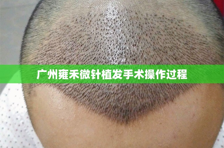  广州雍禾微针植发手术操作过程 