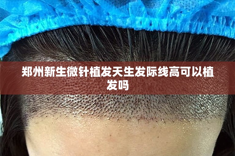 郑州新生微针植发天生发际线高可以植发吗