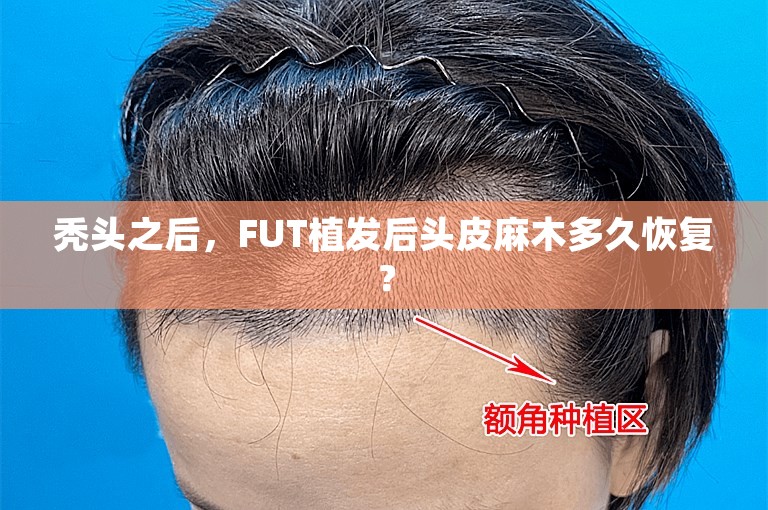 秃头之后，FUT植发后头皮麻木多久恢复？