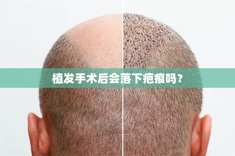 台州技术好的植发门诊选择攻略
