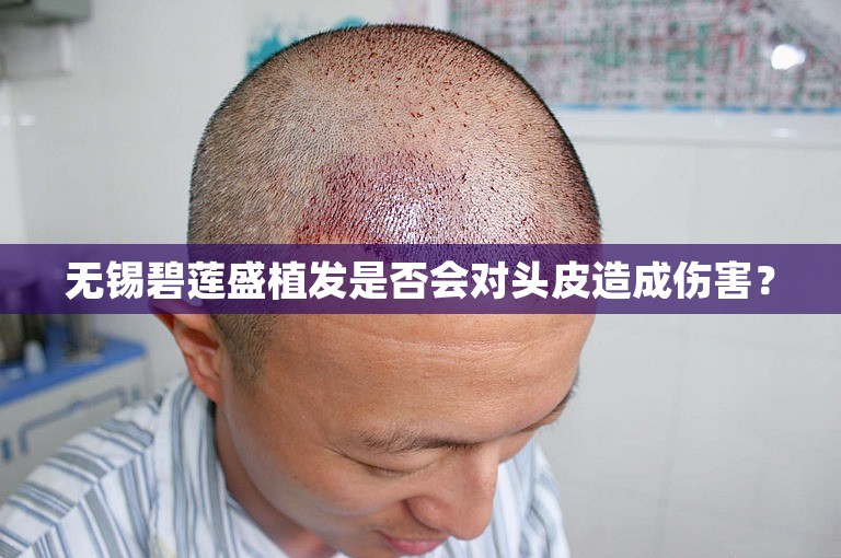 无锡碧莲盛植发是否会对头皮造成伤害？