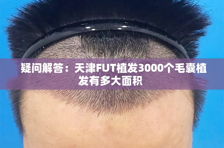  疑问解答：天津FUT植发3000个毛囊植发有多大面积 