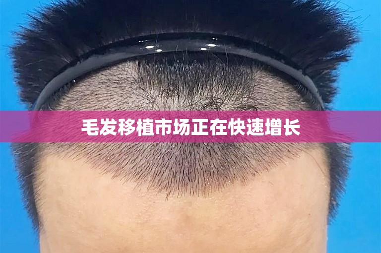 重庆最可靠的植发医院选择攻略