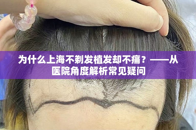 为什么上海不剃发植发却不痛？——从医院角度解析常见疑问