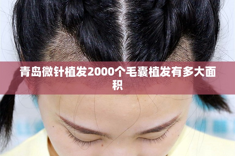 青岛微针植发2000个毛囊植发有多大面积