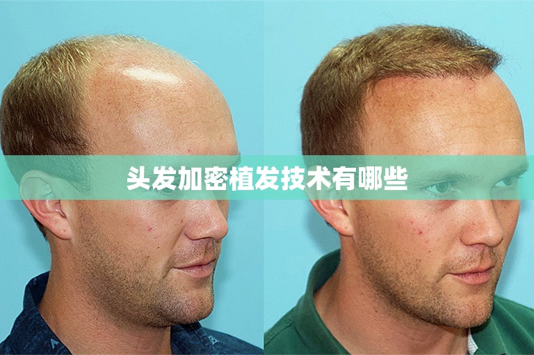 广州著名的植发医生选择方案
