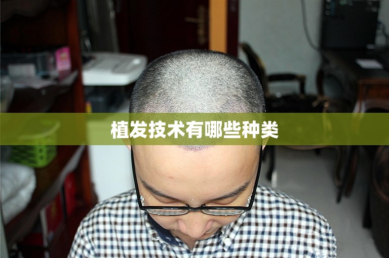 深圳知名的植发医生选择攻略
