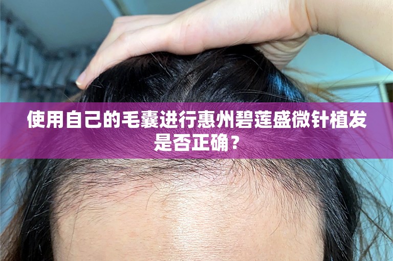 使用自己的毛囊进行惠州碧莲盛微针植发是否正确？