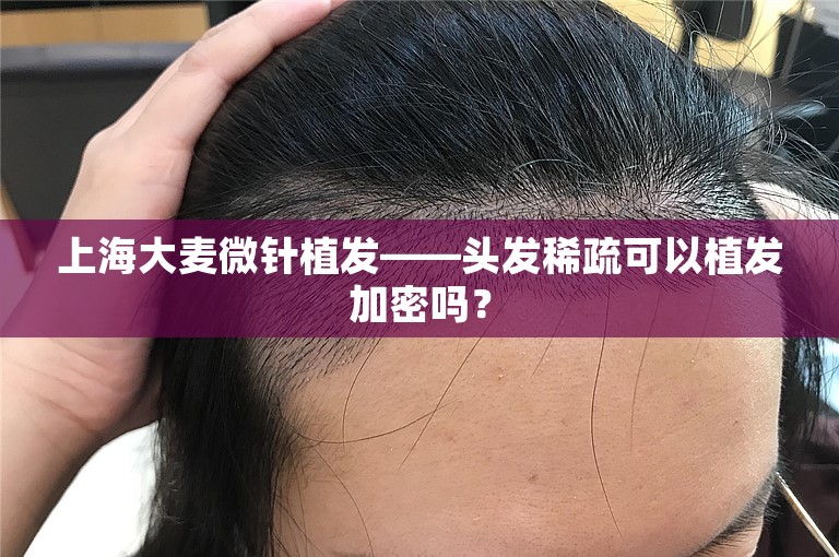 上海大麦微针植发——头发稀疏可以植发加密吗？