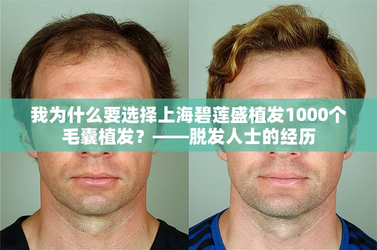 我为什么要选择上海碧莲盛植发1000个毛囊植发？——脱发人士的经历