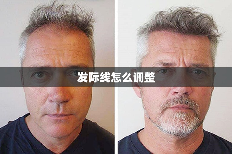 外国人如何挑选靠谱的植发医院在深圳