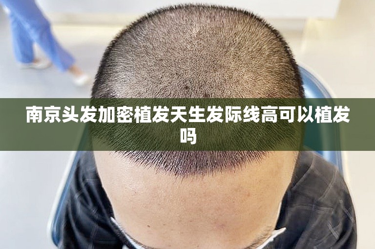南京头发加密植发天生发际线高可以植发吗