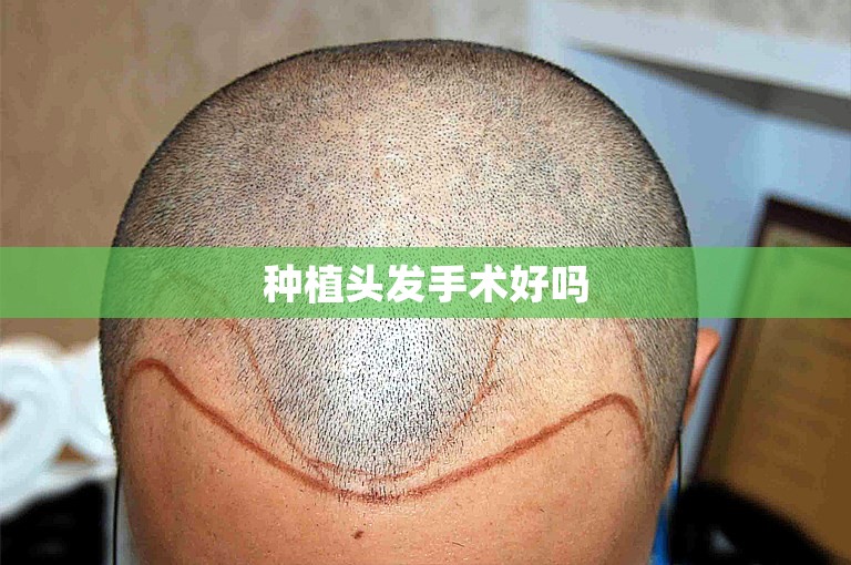 杭州技术最好的植发专家选择方案
