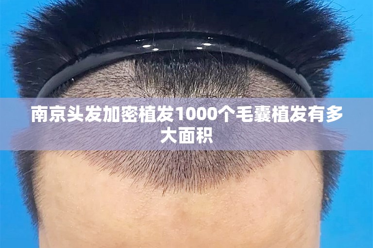 南京头发加密植发1000个毛囊植发有多大面积