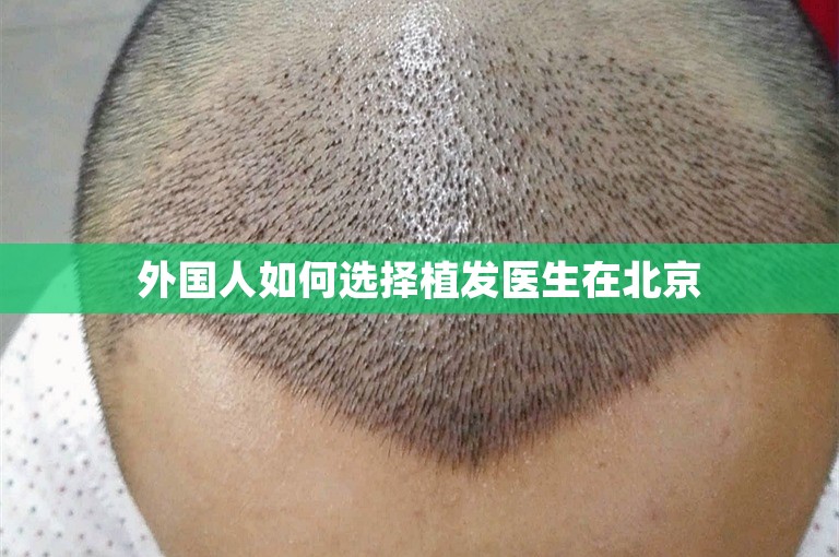 外国人如何选择植发医生在北京
