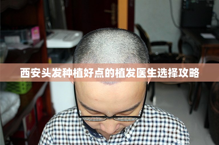 西安头发种植好点的植发医生选择攻略