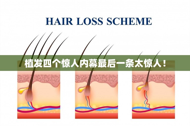 台州头发种植好点的植发医院选择攻略