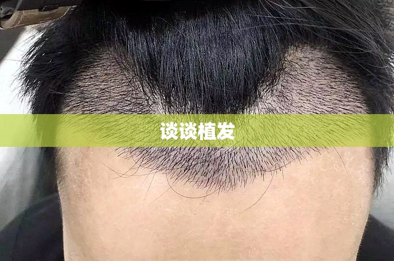 天津最可靠的植发医生选择方案