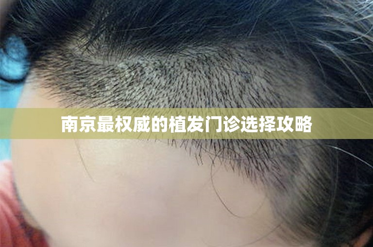 南京最权威的植发门诊选择攻略