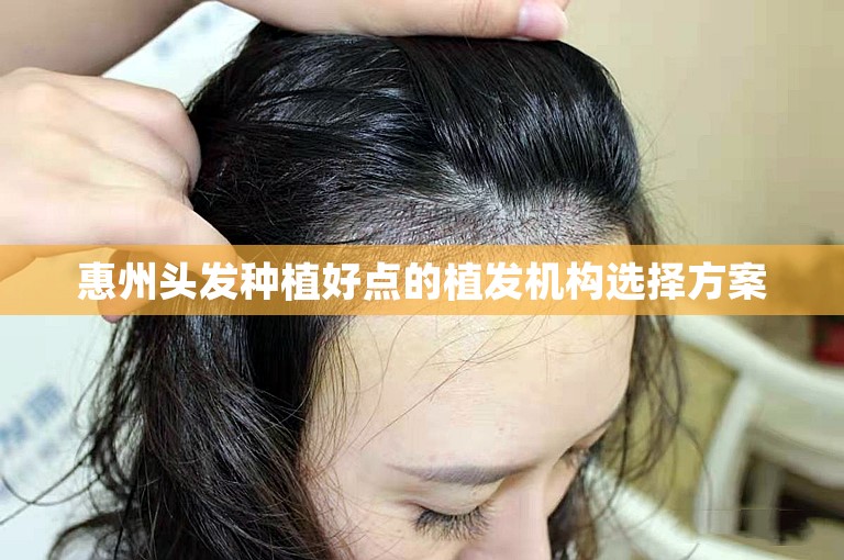 惠州头发种植好点的植发机构选择方案
