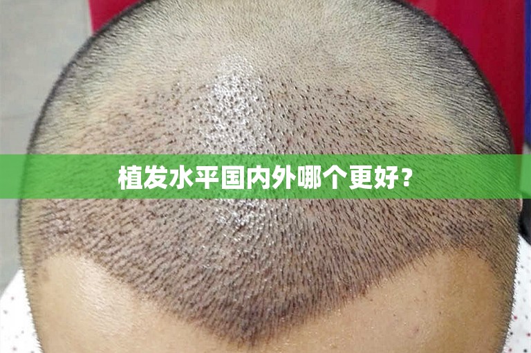 天津最权威的植发医院选择方案