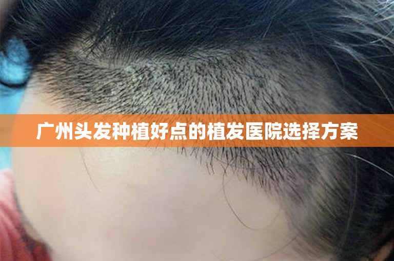 广州头发种植好点的植发医院选择方案