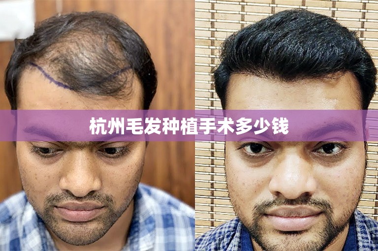 外国人如何选择专业的植发医生在惠州