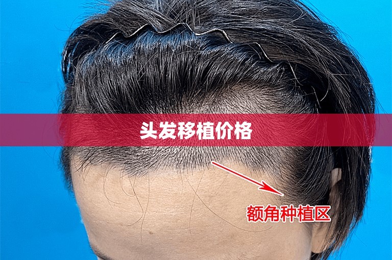 中国头发种植好点的植发机构选择攻略
