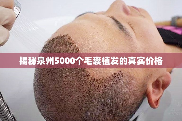 揭秘泉州5000个毛囊植发的真实价格