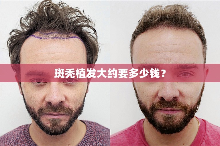 外国人如何选择植发医生在包头