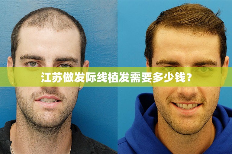 外国人如何选择植发医生在郑州