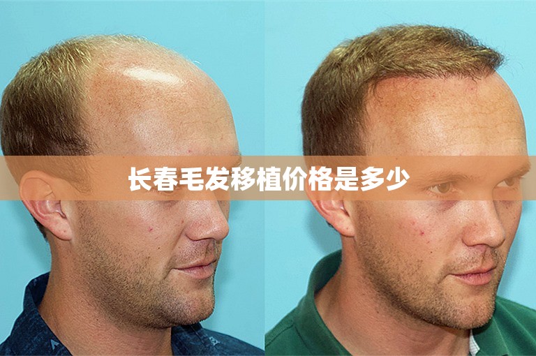 外国人如何选择专业的植发医生在西安