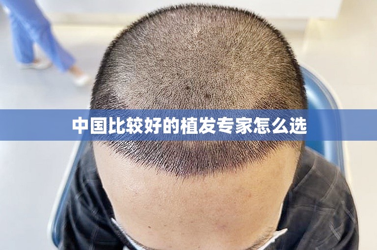 中国比较好的植发专家怎么选