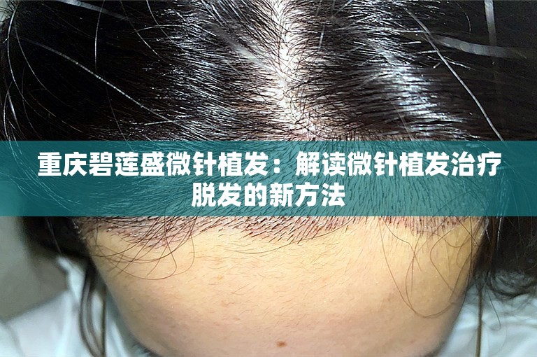 重庆碧莲盛微针植发：解读微针植发治疗脱发的新方法