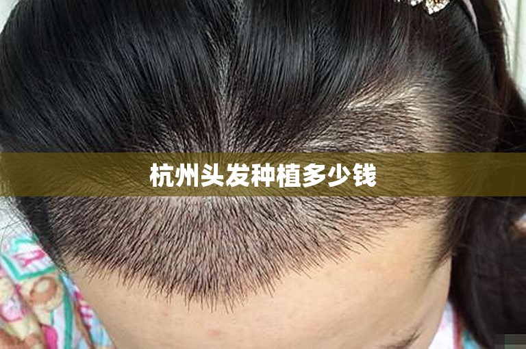 杭州头发种植多少钱