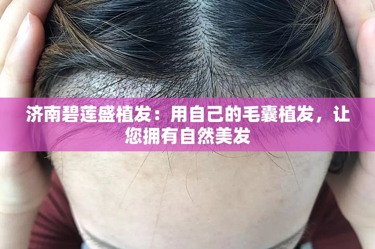 济南碧莲盛植发：用自己的毛囊植发，让您拥有自然美发